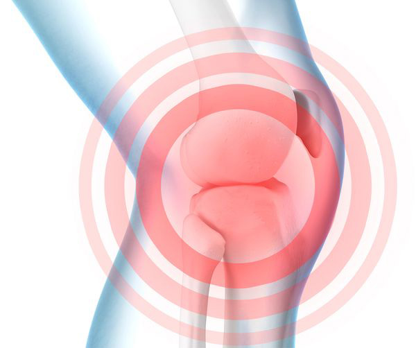 Knee Pain Illustration Highlighting Joint Inflammation and Discomfort Illustration of knee pain with red target circles highlighting the knee joint.
