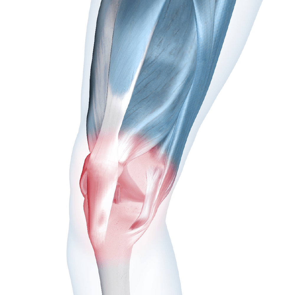Illustration of knee joint highlighting the area affected by sore knees.