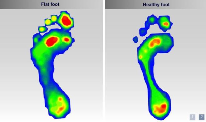 Image comparing the pressure points placed on a healthy foot and a flat foot. Image comparing the pressure points placed on a healthy foot and a flat foot.